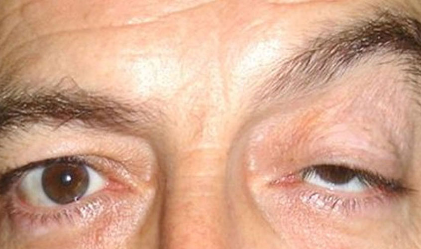 Eyelid diseases and ptosis surgery