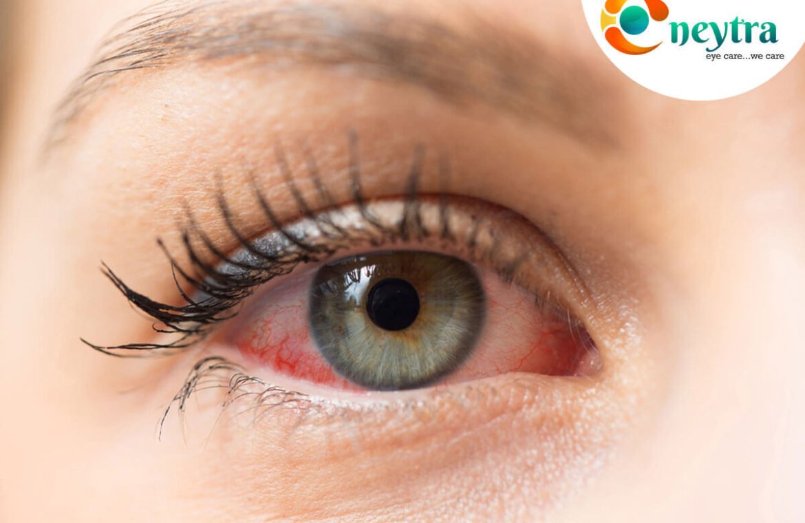 Dry eyes during winters