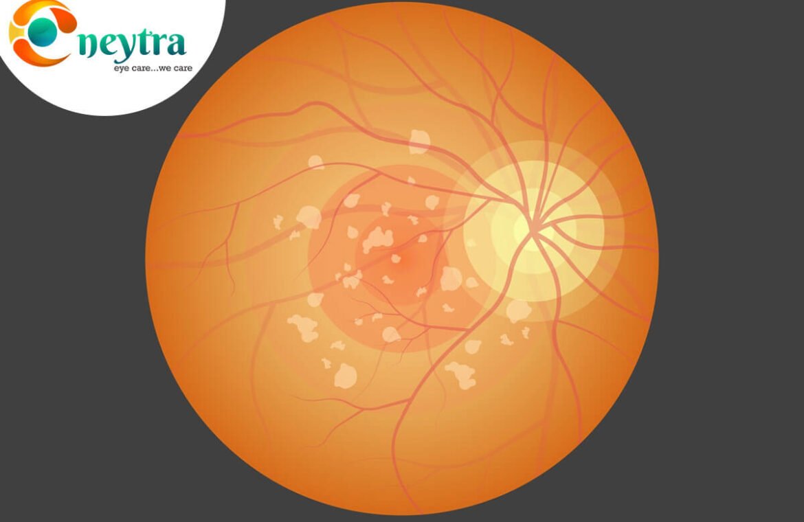 Everything you need to know about Age-Related Macular Degeneration