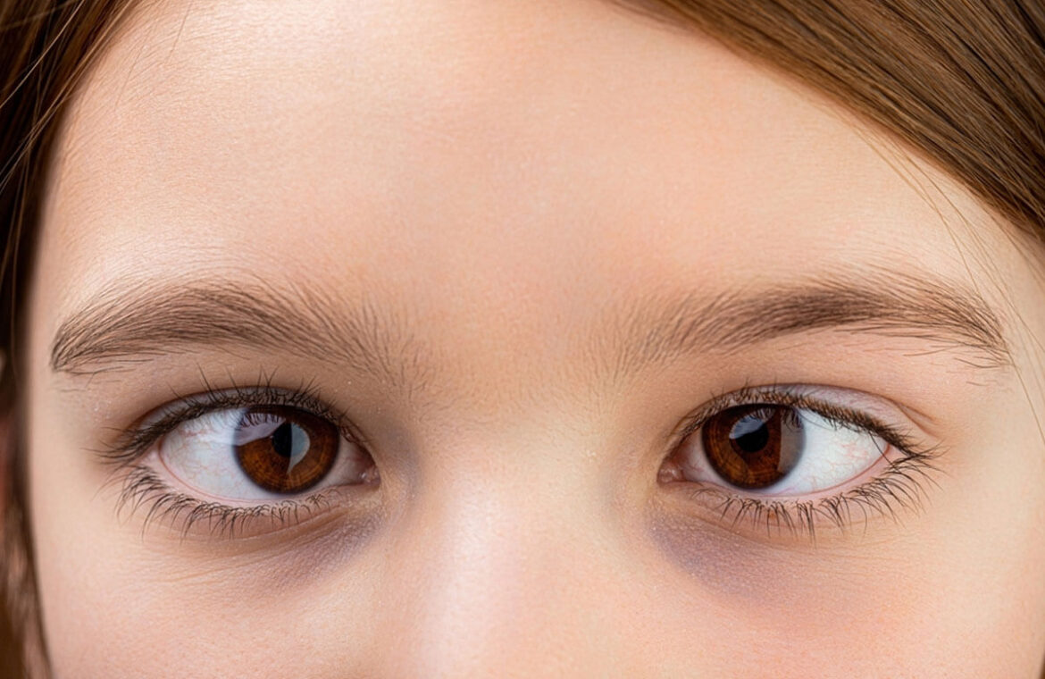 Symptoms-and-causes-of-Squint-in-Children