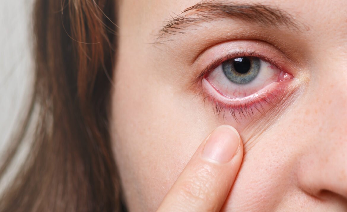 Neytra Eye Centre 25 medicine health care eyesight concept unrecognizable female shows her inflated red eye with blood capillary