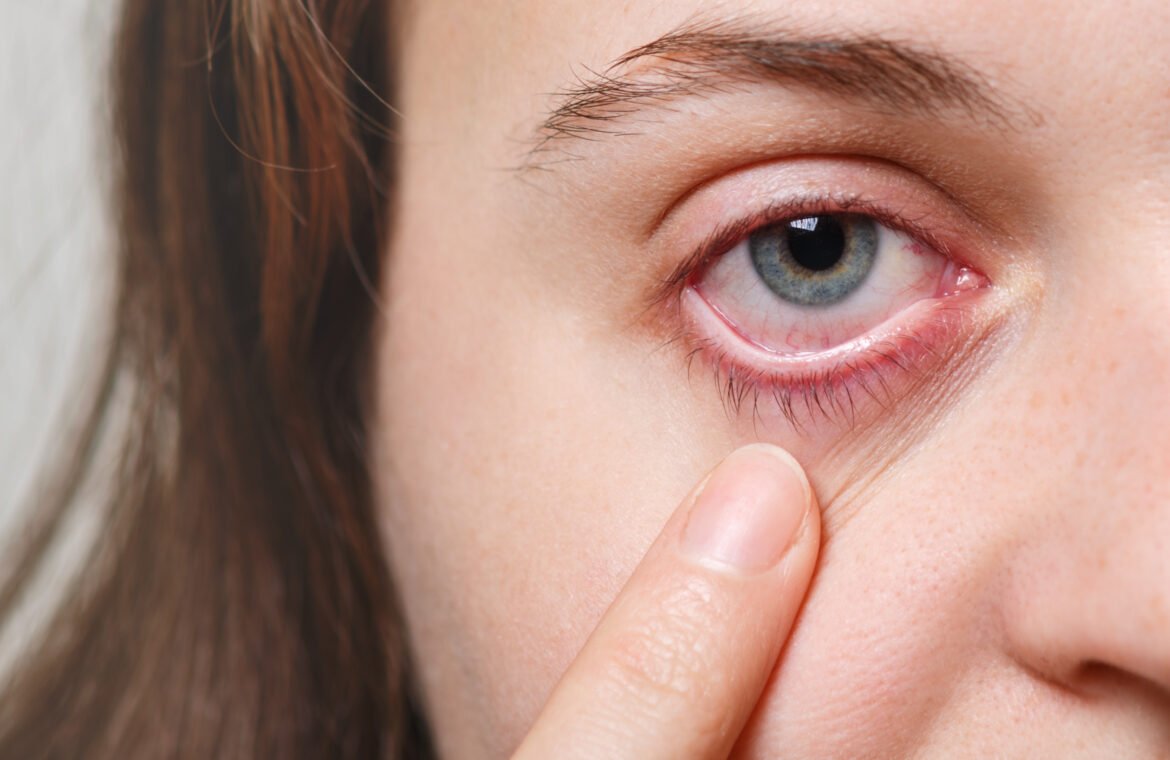 medicine health care eyesight concept unrecognizable female shows her inflated red eye with blood capillary