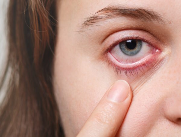 medicine health care eyesight concept unrecognizable female shows her inflated red eye with blood capillary